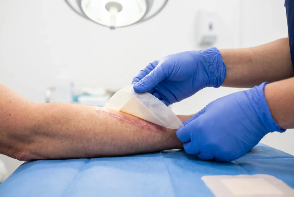 A burn dressing being applied to a healing mark on a forearm, the injury pattern left by a fire show rope