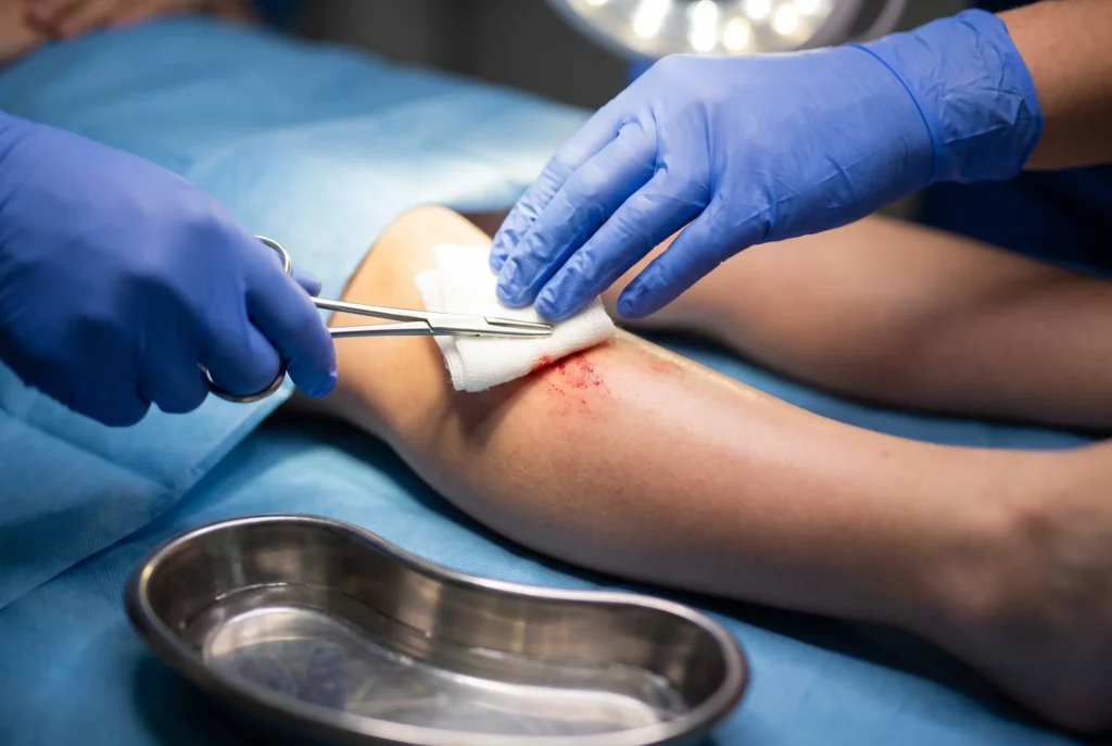 Gloved hands cleaning a graze on a shin with sterile gauze and saline at the Koh Phi Phi clinic